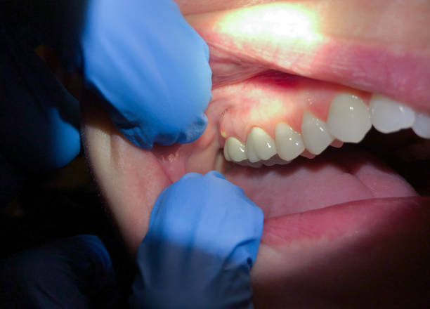 Best Emergency Dentist for Knocked-Out Tooth in Deerfield, IL